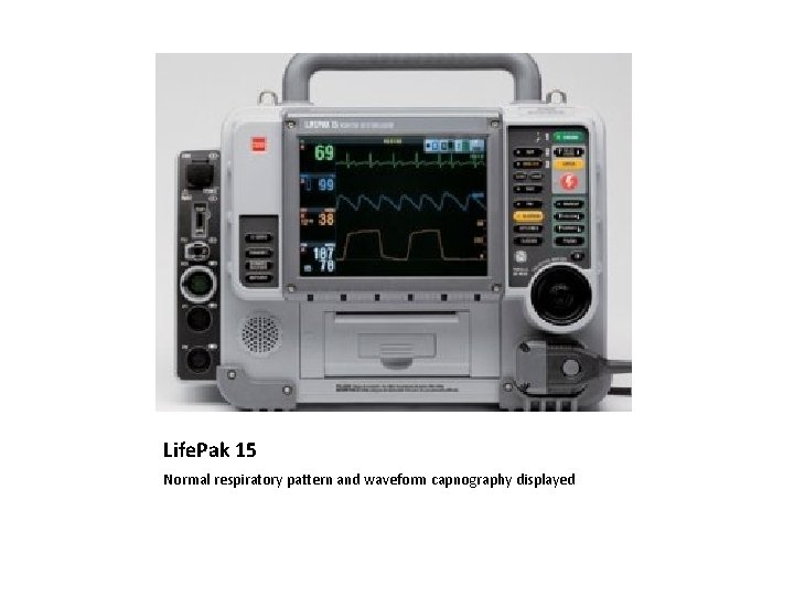 Life. Pak 15 Normal respiratory pattern and waveform capnography displayed 