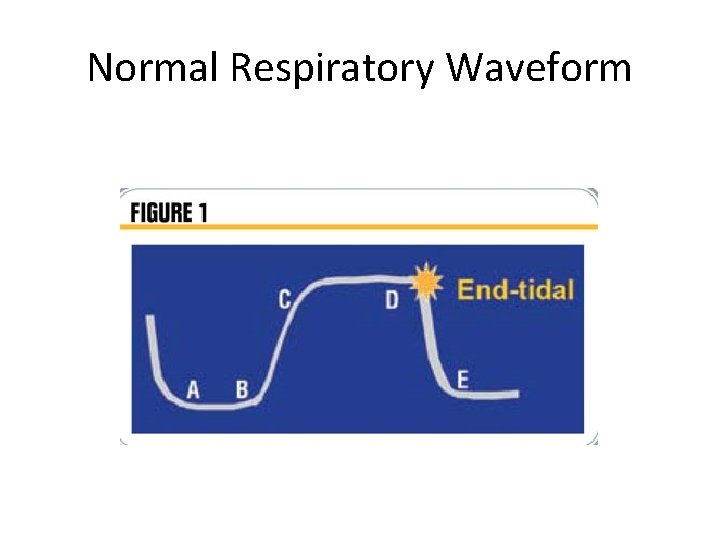 Normal Respiratory Waveform 