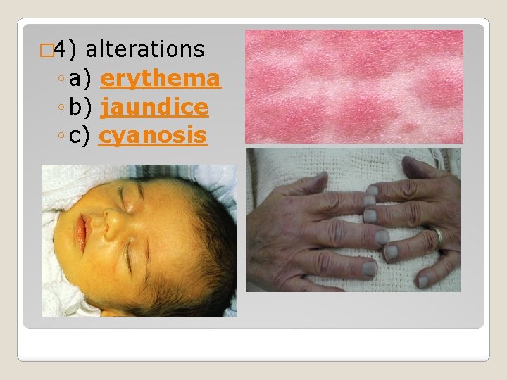 � 4) alterations ◦ a) erythema ◦ b) jaundice ◦ c) cyanosis � 4) alterations ◦ a) erythema ◦ b) jaundice ◦ c) cyanosis