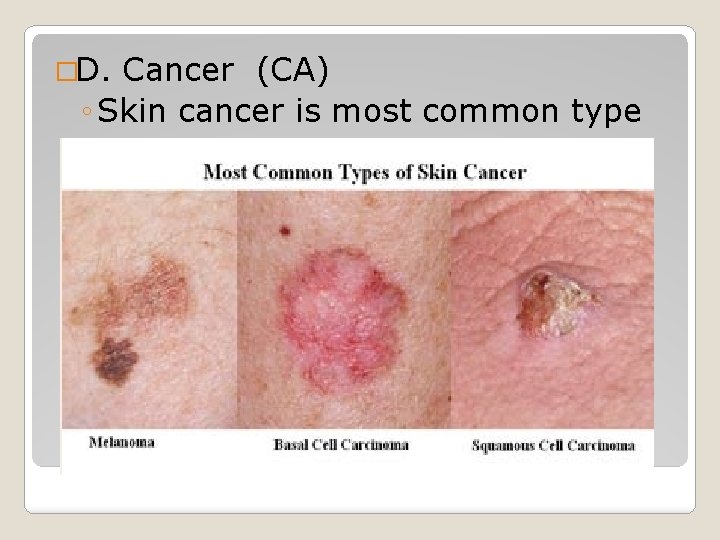 �D. Cancer (CA) ◦ Skin cancer is most common type ◦ �D. Cancer (CA) ◦ Skin cancer is most common type ◦