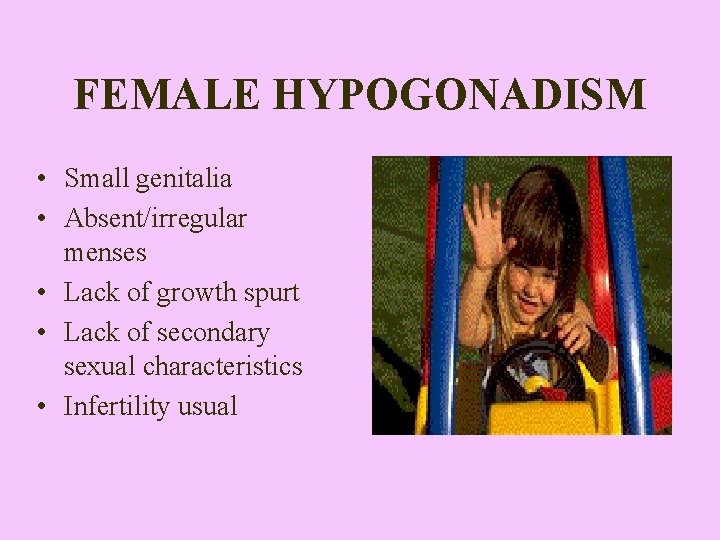 FEMALE HYPOGONADISM • Small genitalia • Absent/irregular menses • Lack of growth spurt •