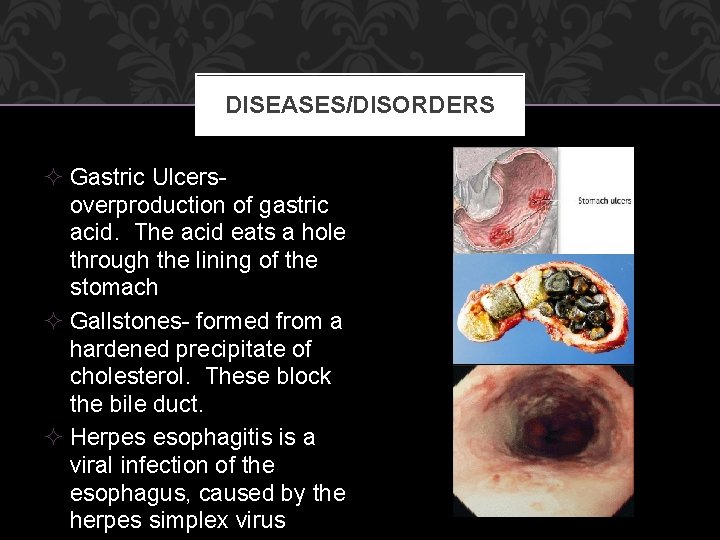 DISEASES/DISORDERS ² Gastric Ulcersoverproduction of gastric acid. The acid eats a hole through the