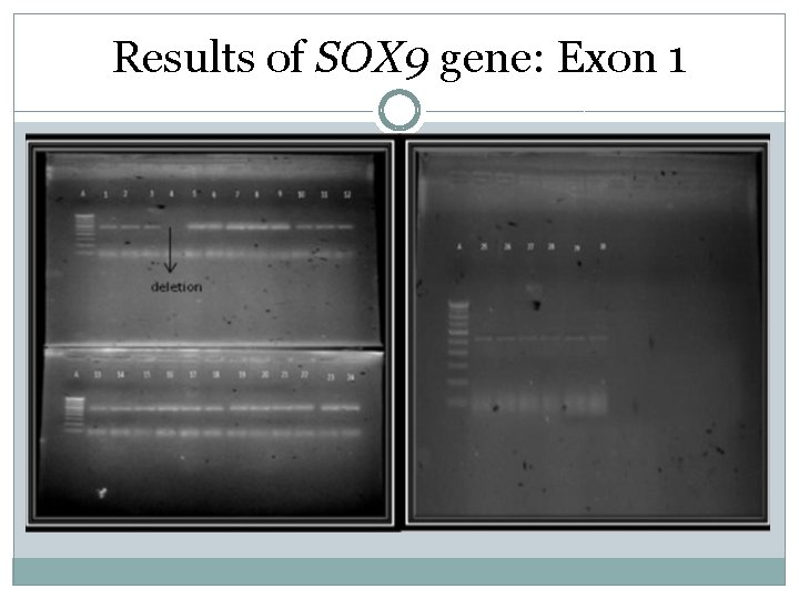 Results of SOX 9 gene: Exon 1 Results of SOX 9 gene: Exon 1