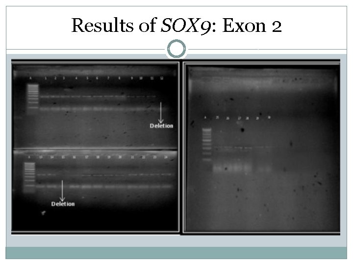 Results of SOX 9: Exon 2 Results of SOX 9: Exon 2