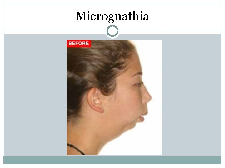 Micrognathia Micrognathia