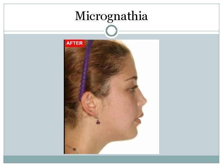 Micrognathia Micrognathia