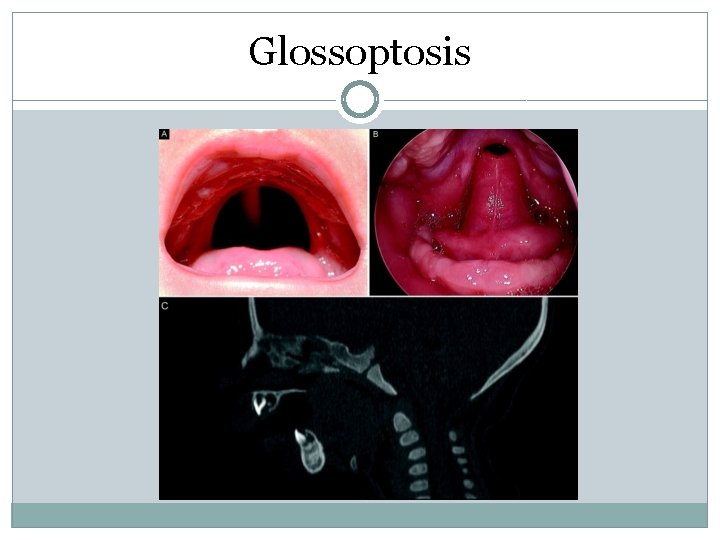 Glossoptosis Glossoptosis