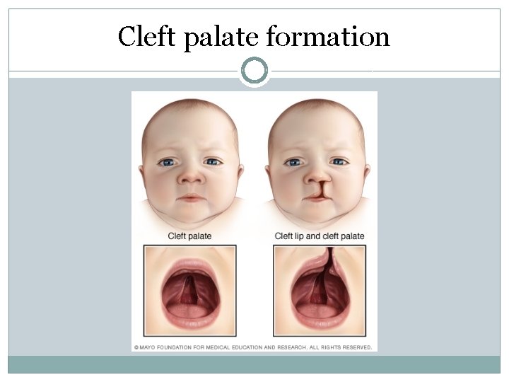 Cleft palate formation Cleft palate formation