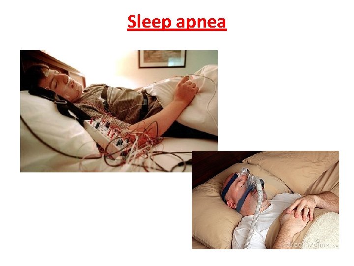 Sleep apnea 