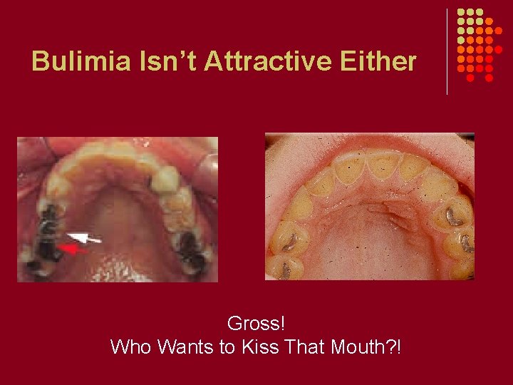 Bulimia Isn’t Attractive Either Gross! Who Wants to Kiss That Mouth? ! 