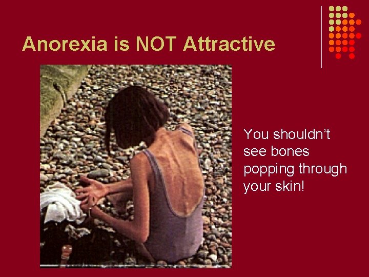 Anorexia is NOT Attractive You shouldn’t see bones popping through your skin! 