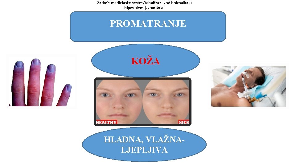 Zadaće medicinske sestre/tehničara kod bolesnika u hipovolemijskom šoku PROMATRANJE KOŽA HLADNA, VLAŽNALJEPLJIVA 