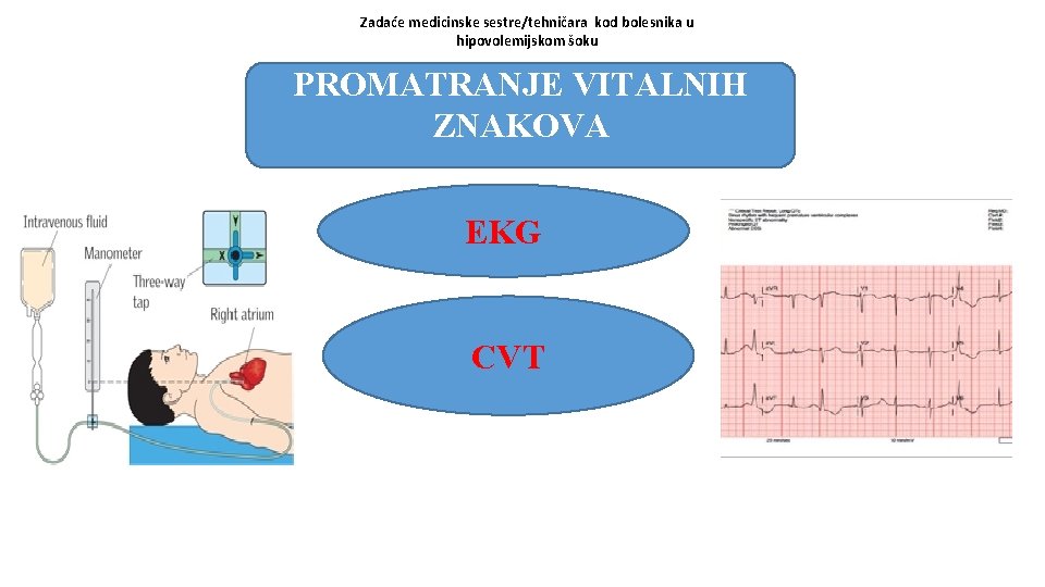 Zadaće medicinske sestre/tehničara kod bolesnika u hipovolemijskom šoku PROMATRANJE VITALNIH ZNAKOVA EKG CVT 
