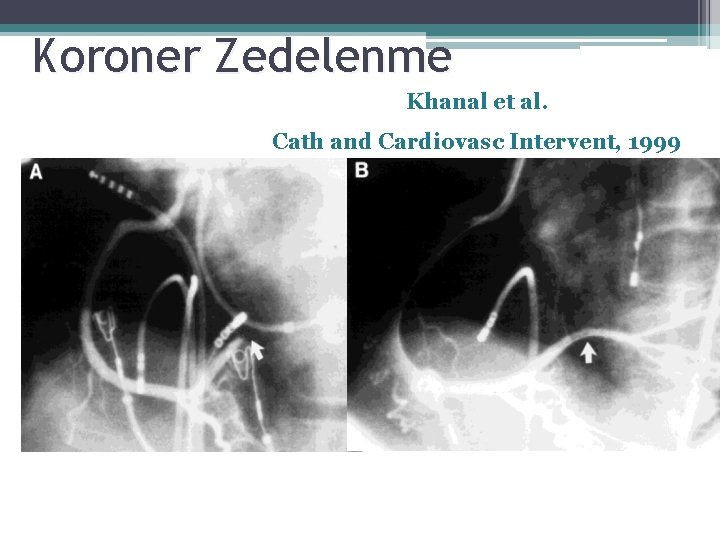 Koroner Zedelenme Khanal et al. Cath and Cardiovasc Intervent, 1999 