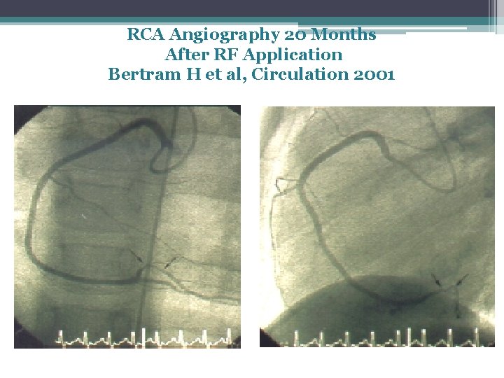 RCA Angiography 20 Months After RF Application Bertram H et al, Circulation 2001 