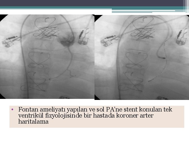  • Fontan ameliyatı yapılan ve sol PA’ne stent konulan tek ventrikül fizyolojisinde bir