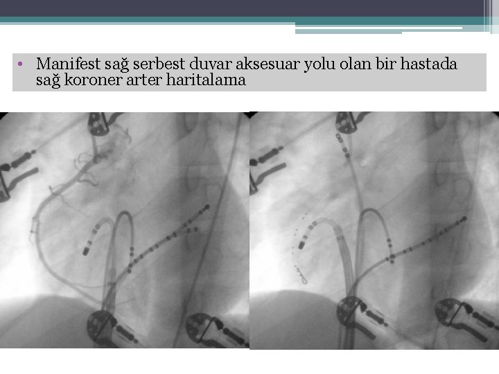  • Manifest sağ serbest duvar aksesuar yolu olan bir hastada sağ koroner arter