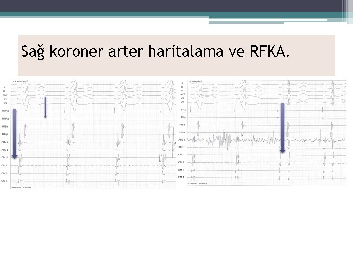 Sağ koroner arter haritalama ve RFKA. 