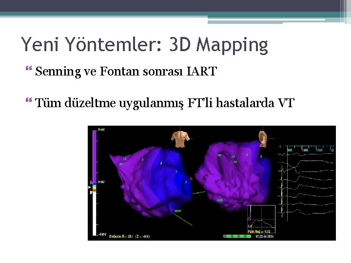 Yeni Yöntemler: 3 D Mapping Senning ve Fontan sonrası IART Tüm düzeltme uygulanmış FT’li