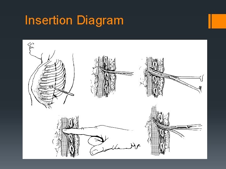 Insertion Diagram 