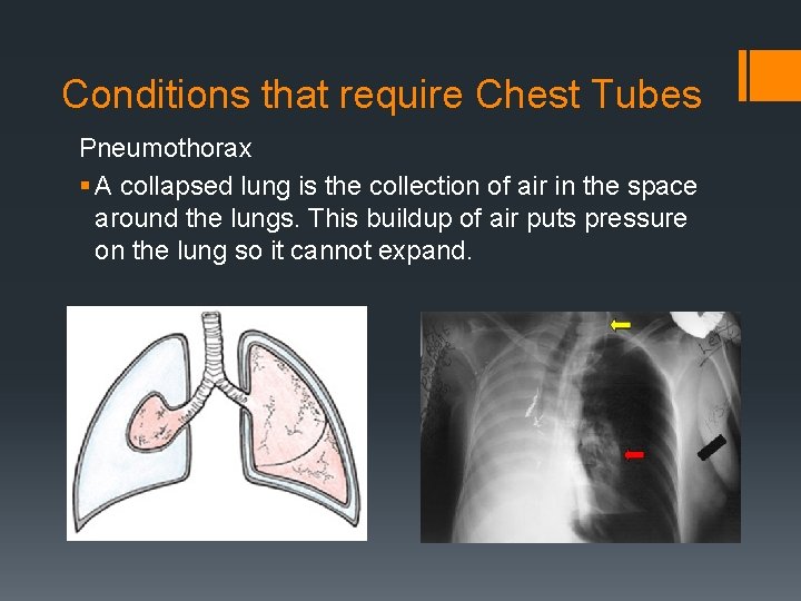 Conditions that require Chest Tubes Pneumothorax § A collapsed lung is the collection of