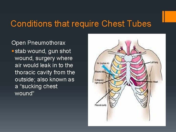 Conditions that require Chest Tubes Open Pneumothorax § stab wound, gun shot wound, surgery