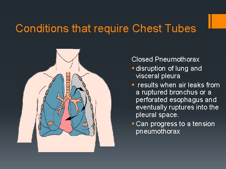 Conditions that require Chest Tubes Closed Pneumothorax § disruption of lung and visceral pleura