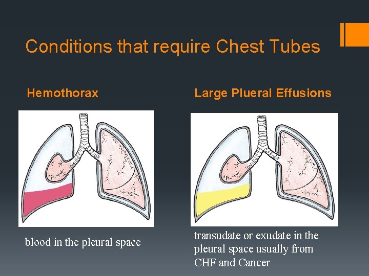 Conditions that require Chest Tubes Hemothorax blood in the pleural space Large Plueral Effusions