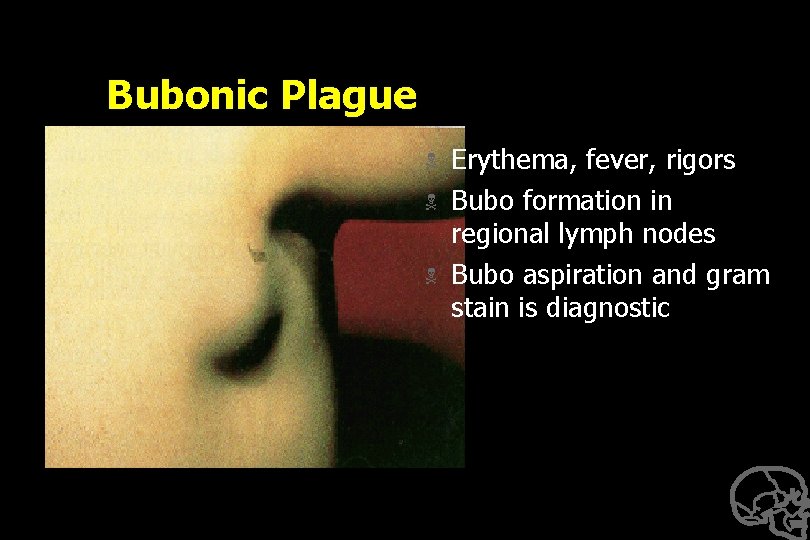 Bubonic Plague N N N Erythema, fever, rigors Bubo formation in regional lymph nodes