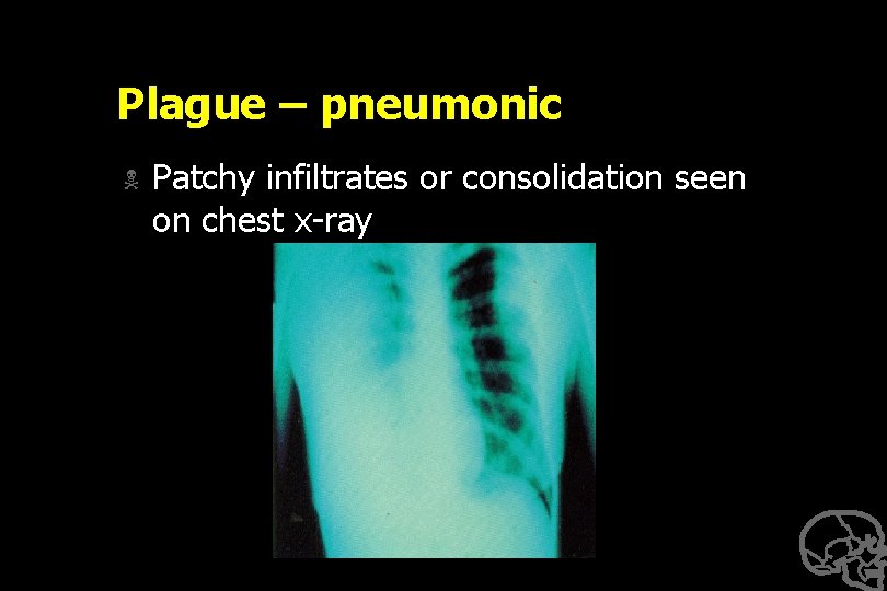 Plague – pneumonic N Patchy infiltrates or consolidation seen on chest x-ray 