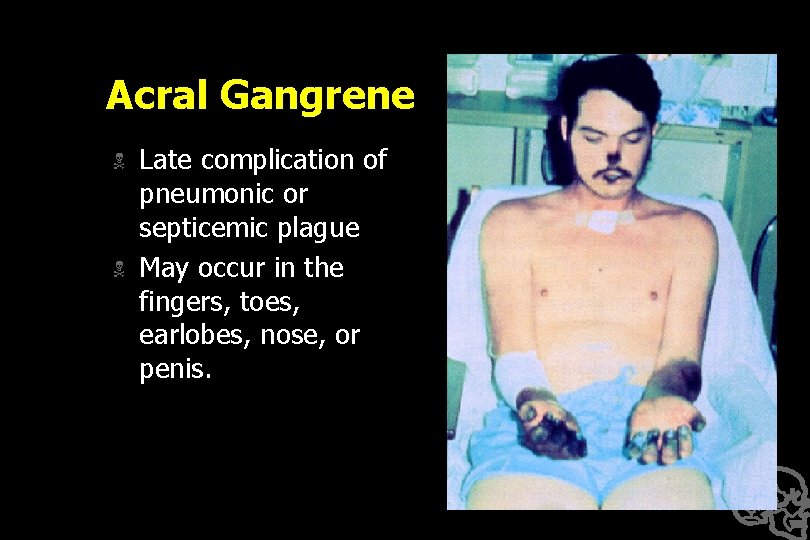 Acral Gangrene N N Late complication of pneumonic or septicemic plague May occur in