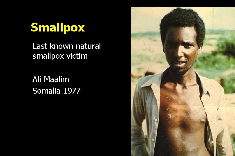 Smallpox Last known natural smallpox victim Ali Maalim Somalia 1977 