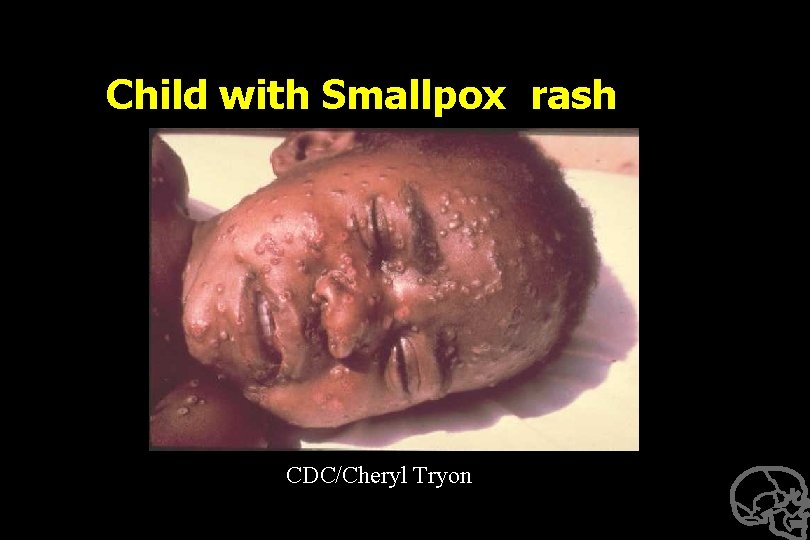 Child with Smallpox rash CDC/Cheryl Tryon 