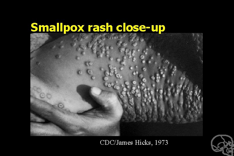 Smallpox rash close-up CDC/James Hicks, 1973 