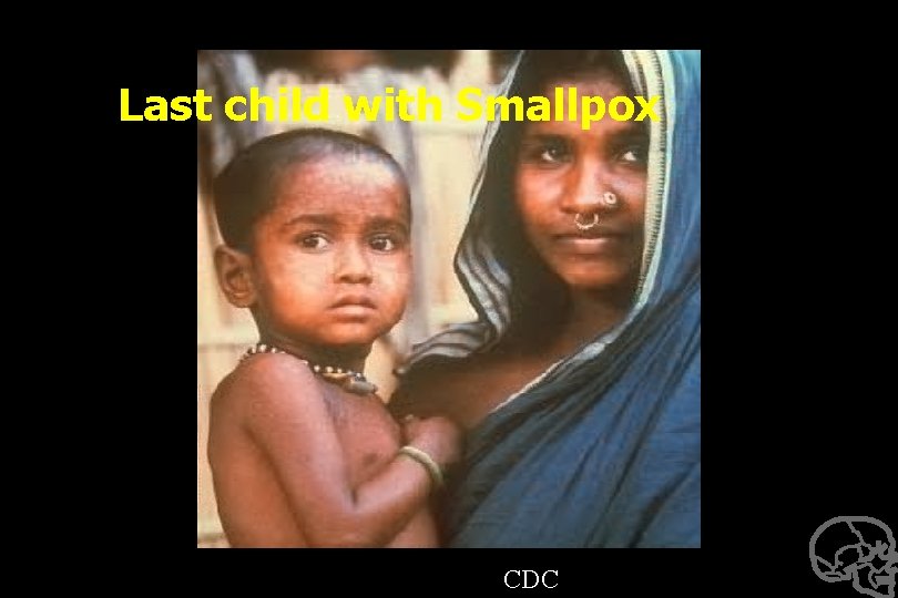 Last child with Smallpox CDC 