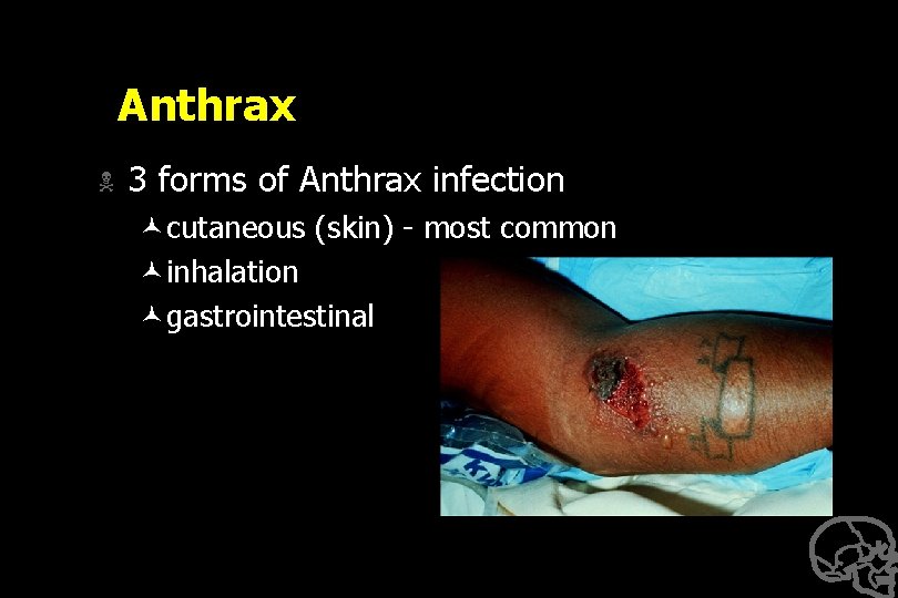 Anthrax N 3 forms of Anthrax infection ©cutaneous (skin) - most common ©inhalation ©gastrointestinal