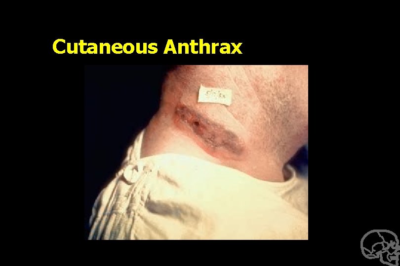 Cutaneous Anthrax 