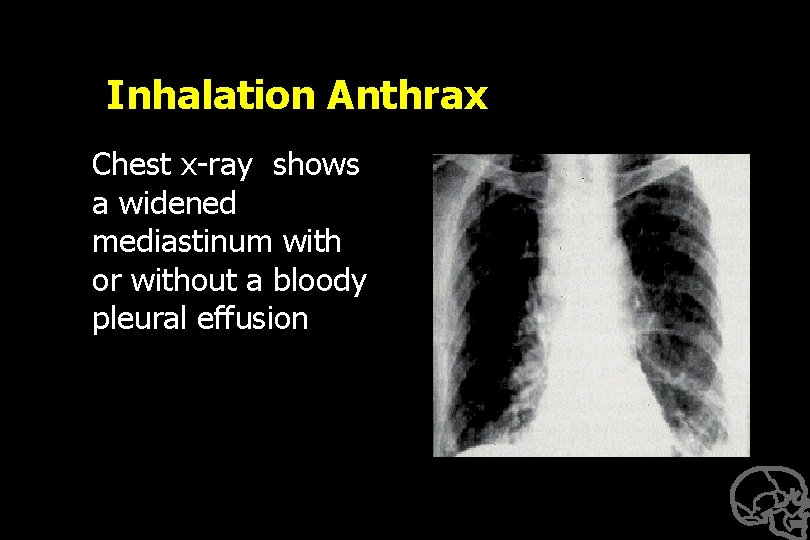 Inhalation Anthrax Chest x-ray shows a widened mediastinum with or without a bloody pleural