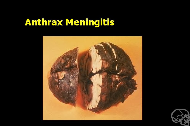 Anthrax Meningitis 