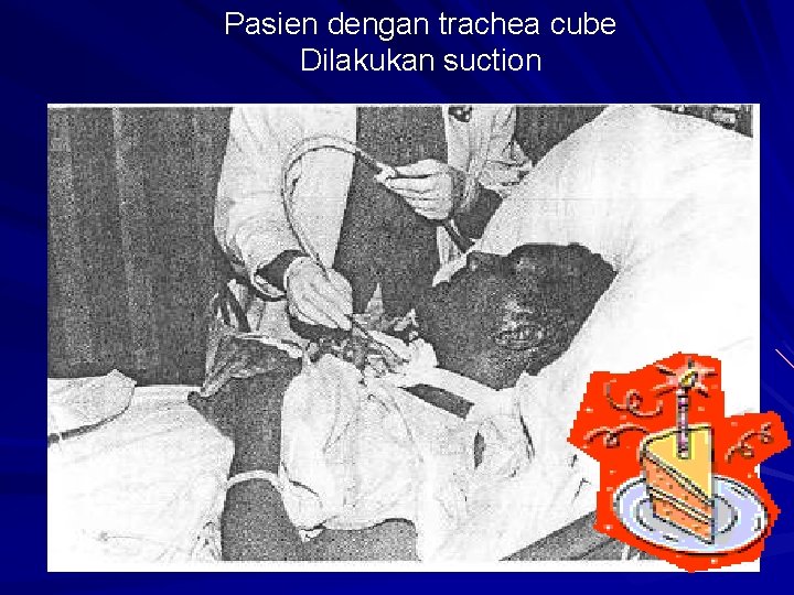 Pasien dengan trachea cube Dilakukan suction 