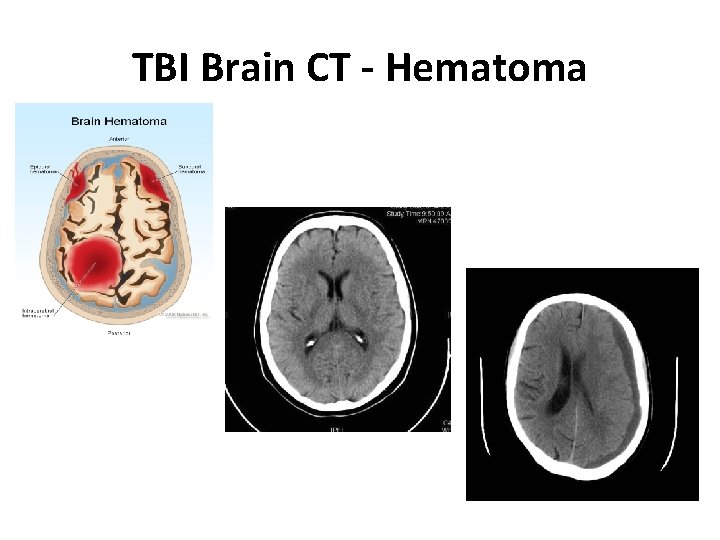 TBI Brain CT - Hematoma 