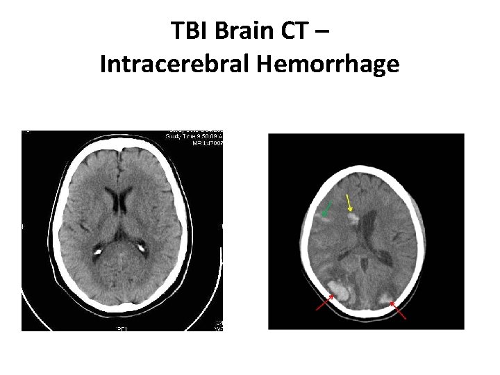 TBI Brain CT – Intracerebral Hemorrhage 