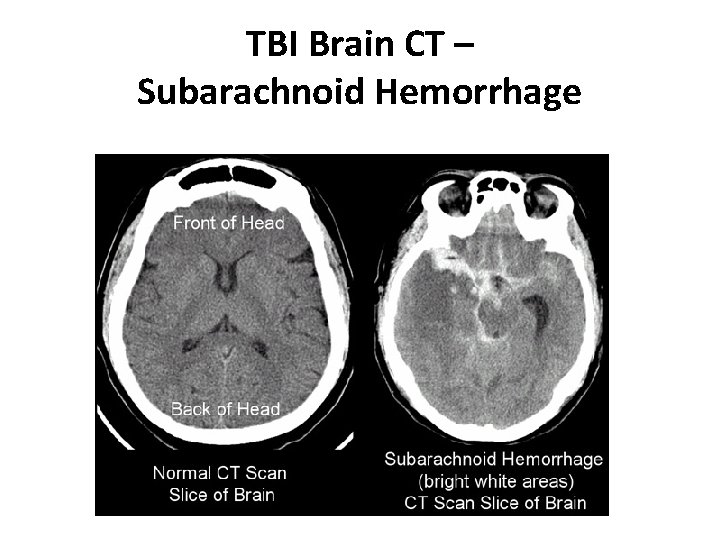 TBI Brain CT – Subarachnoid Hemorrhage 