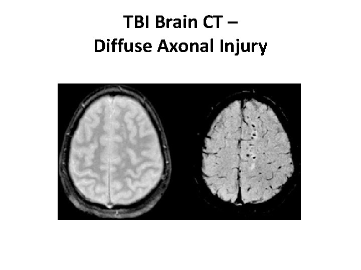 TBI Brain CT – Diffuse Axonal Injury 