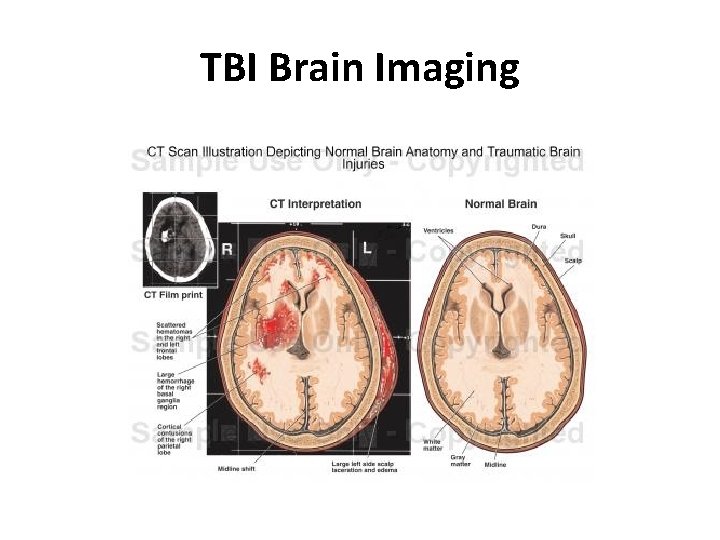 TBI Brain Imaging 