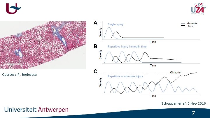 Courtesy P. Bedosssa Schuppan et al. J Hep 2018 7 