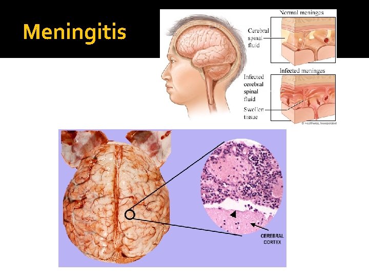 Meningitis 