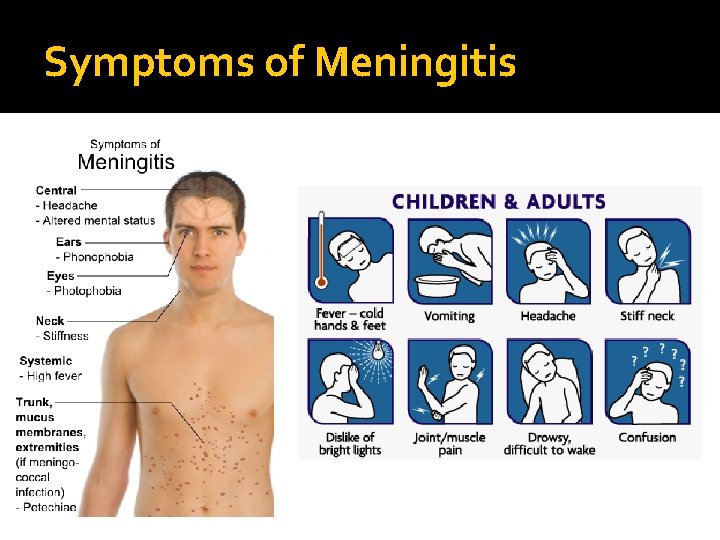 Symptoms of Meningitis 