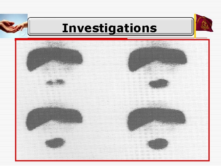 Investigations o Liver Function Tests n Direct and Indirect Bilirubin n ALT n Alkaline