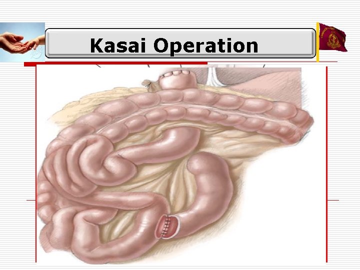 Kasai Operation 